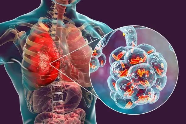 Suman 15 muertes por tuberculosis en Nayarit