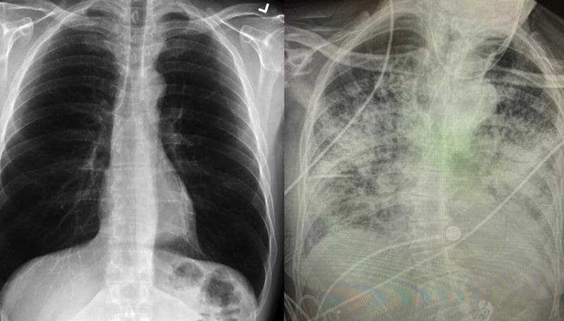 Después de la COVID-19, pulmones podrían quedar más dañados que los de los fumadores